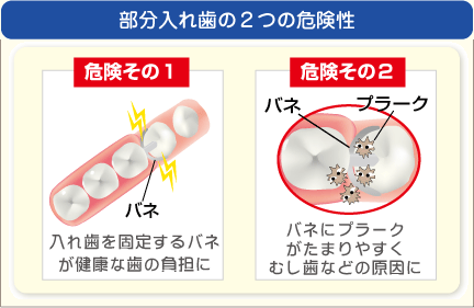 部分入れ歯の２つの危険性